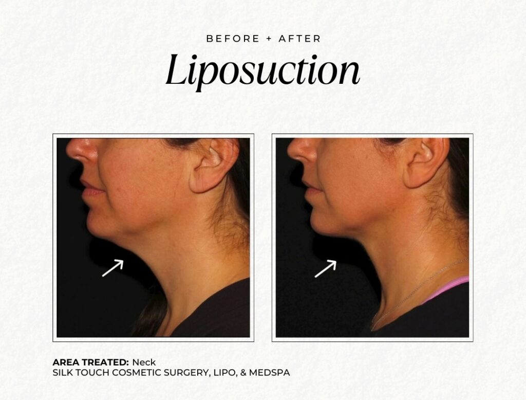 Before and after of neck lipo at silk touch cosmetic surgery lipo and medspa