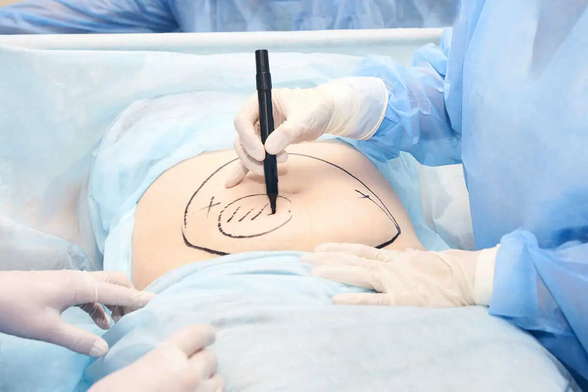 Liposuction-Treatment