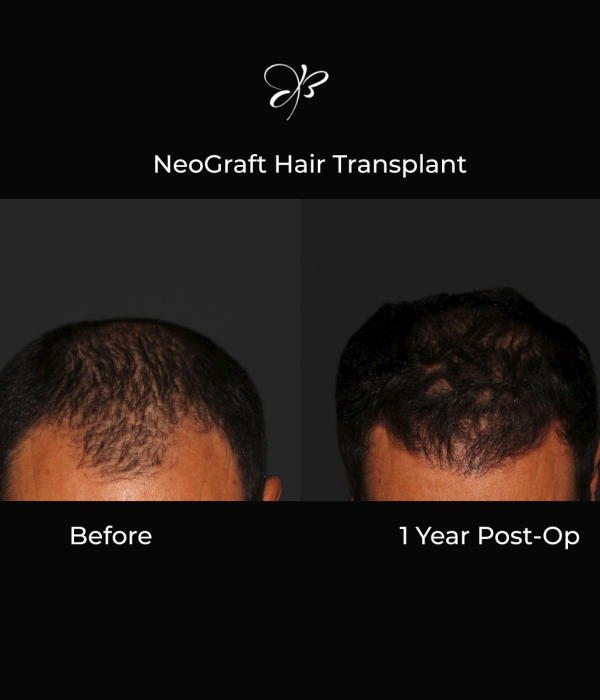 Male pre and post op of a NeoGraft Hair transplant after 1 year shown from the front. Hair Line has returned and natural hair growth has occurred thanks to the physicians at Silk Touch Cosmetic Surgery, Lipo, & medspa in Boise Idaho