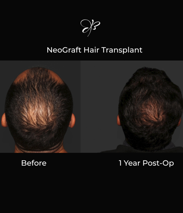 Male pre and post op of a NeoGraft Hair transplant after 1 year shown from the back. Baldness at the crown of the head has returned and natural hair growth has occurred thanks to the physicians at Silk Touch Cosmetic Surgery, Lipo, & medspa in Boise Idaho