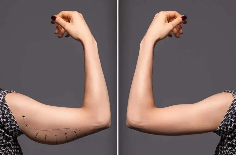 Arm-lift in Boise, ID by Silk Touch Cosmetic Surgery, Lipo, & Medspa