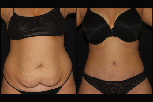 Lipo 360 tummy tuck d