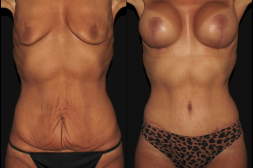 before and after from the front view of a mommy makeover including breast augmentation, breast lift and tummy tuck