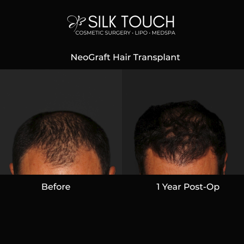 NeoGraft Hair Transplant before and after of male patient from Silk touch cosmetic surgery, lipo, and medspa in boise, idaho