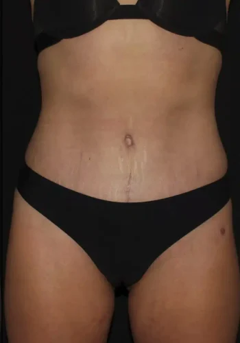 Silk_Touch-mai-abdominoplasty-case-b-after-a-In-Boise-ID