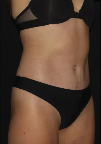 Silk_Touch-mai-abdominoplasty-case-b-after-b-In-Boise-ID