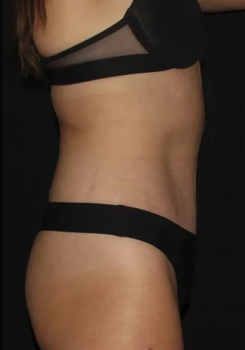 Silk_Touch-mai-abdominoplasty-case-b-after-c-In-Boise-ID