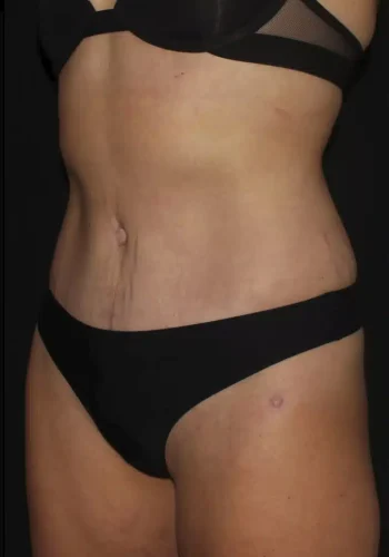 Silk_Touch-mai-abdominoplasty-case-b-after-d-In-Boise-ID