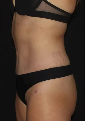 Silk_Touch-mai-abdominoplasty-case-b-after-e-In-Boise-ID