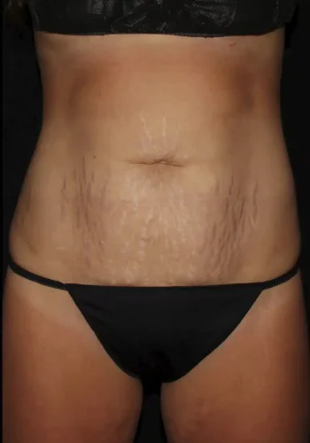 Silk_Touch-mai-abdominoplasty-case-b-before-a-In-Boise-ID