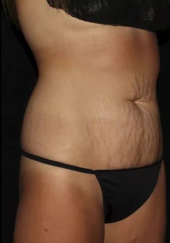 Silk_Touch-mai-abdominoplasty-case-b-before-b-In-Boise-ID