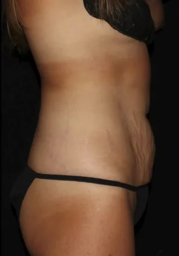 Silk_Touch-mai-abdominoplasty-case-b-before-c-In-Boise-ID