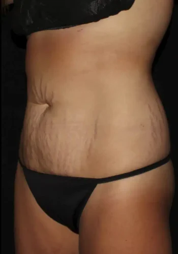 Silk_Touch-mai-abdominoplasty-case-b-before-d-In-Boise-ID