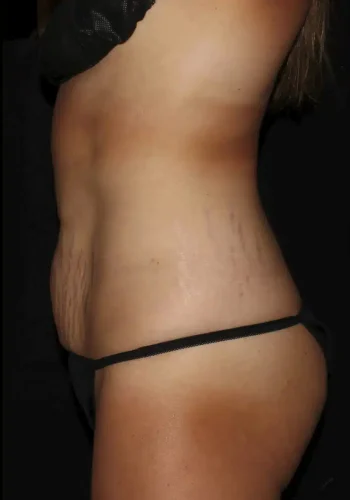 Silk_Touch-mai-abdominoplasty-case-b-before-e-In-Boise-ID