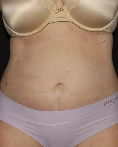 Silk_Touch-mai-abdominoplasty-case-c-after-a-In-Boise-ID