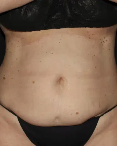 Silk_Touch-mai-abdominoplasty-case-c-before-a-In-Boise-ID