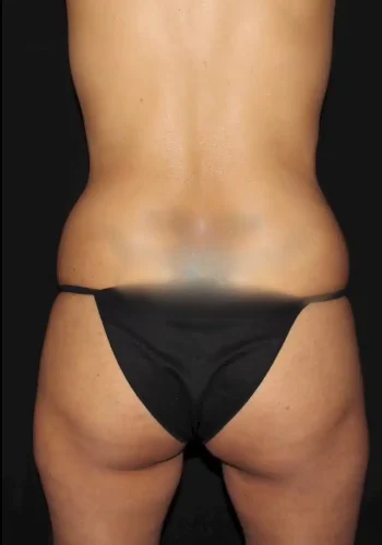 Silk_Touch-mai-bbl-lipo-tummy-case-a-before-c-In-Boise-ID