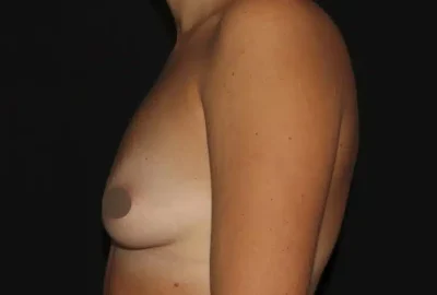 Silk_Touch-mai-breast-augumentation-aa-before-c-In-Boise-ID