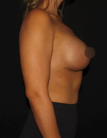 Silk_Touch-mai-breast-augumentation-after-f-In-Boise-ID