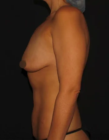 Silk_Touch-mai-breast-augumentation-before-e-In-Boise-ID