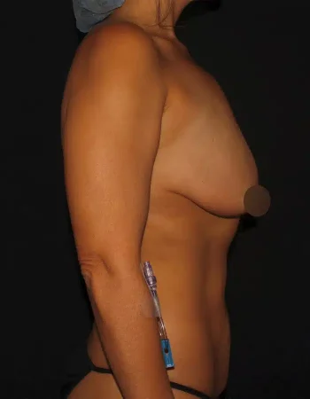 Silk_Touch-mai-breast-augumentation-before-f-In-Boise-ID