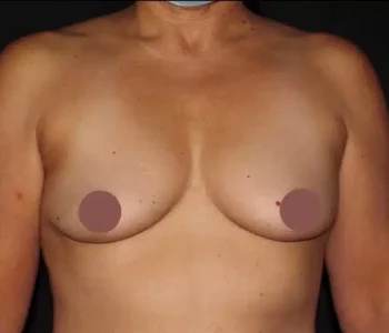 Silk_Touch-mai-breast-augumentation-case-h-before-b-In-Boise-ID