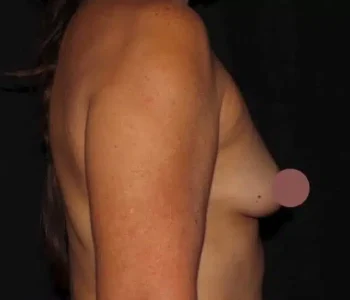 Silk_Touch-mai-breast-augumentation-case-h-before-d-In-Boise-ID