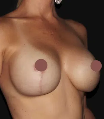 Silk_Touch-mai-breast-lift-implant-case-a-after-c-In-Boise-ID