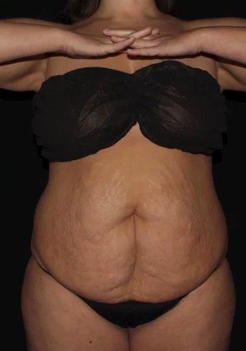 Silk_Touch-mai-lipoabdominoplasty-before-a-In-Boise-ID