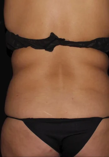 Silk_Touch-mai-lipoabdominoplasty-before-c-In-Boise-ID