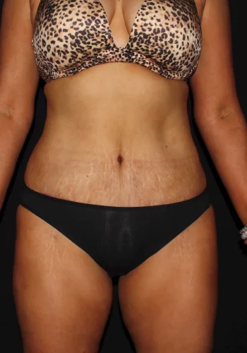 Silk_Touch-mai-lipoabdominoplasty-case-b-after-a-In-Boise-ID