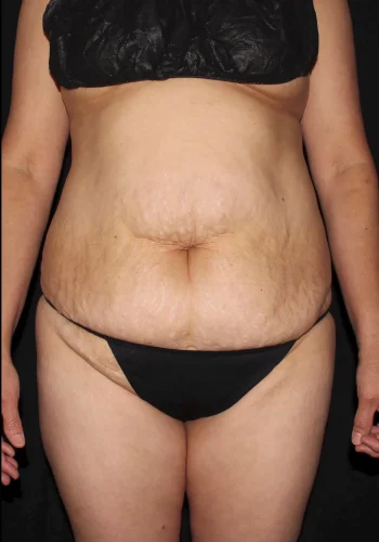 Silk_Touch-mai-lipoabdominoplasty-case-b-before-a-In-Boise-ID