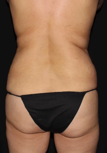 Silk_Touch-mai-lipoabdominoplasty-case-b-before-b-In-Boise-ID