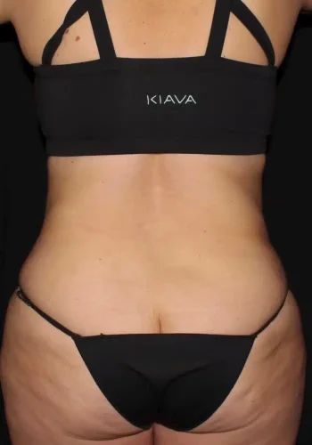 Silk_Touch-mai-lipoabdominoplasty-case-c-after-a-In-Boise-ID