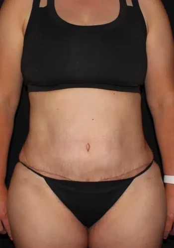 Silk_Touch-mai-lipoabdominoplasty-case-c-after-b-In-Boise-ID