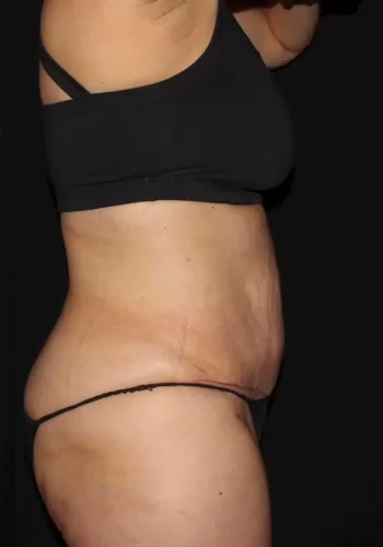 Silk_Touch-mai-lipoabdominoplasty-case-c-after-c-In-Boise-ID