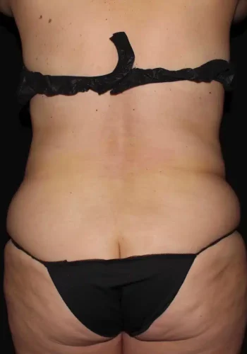 Silk_Touch-mai-lipoabdominoplasty-case-c-before-a-In-Boise-ID