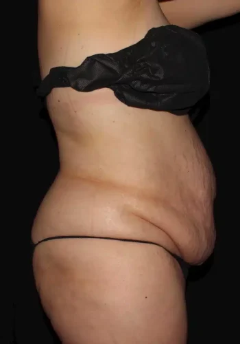 Silk_Touch-mai-lipoabdominoplasty-case-c-before-c-In-Boise-ID