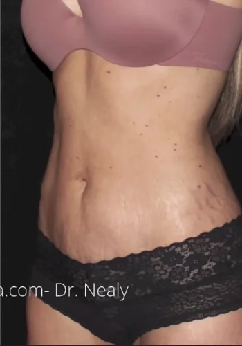 Silk_Touch-mai-lipoabdominoplasty-case-e-after-b-In-Boise-ID