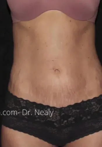 Silk_Touch-mai-lipoabdominoplasty-case-e-before-a-In-Boise-ID