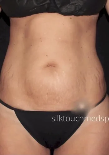 Silk_Touch-mai-lipoabdominoplasty-case-e-before-aa-In-Boise-ID