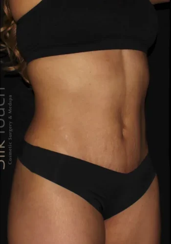 Silk_Touch-mai-mini-tummy-tuck-case-a-after-a-In-Boise-ID