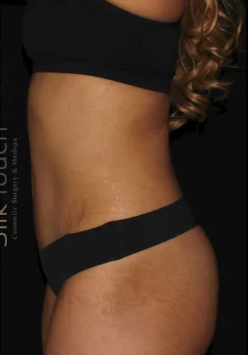 Silk_Touch-mai-mini-tummy-tuck-case-a-after-c-In-Boise-ID