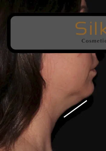 Silk_Touch-mai-neck-case-k-before-e-In-Boise-ID