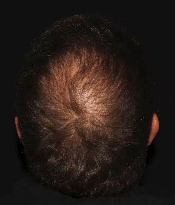 Silk_Touch-mai-neograft-hair-transplant-case-a-after-c-In-Boise-ID