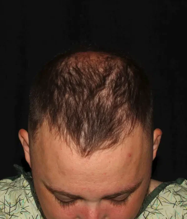 Silk_Touch-mai-neograft-hair-transplant-case-a-before-b-In-Boise-ID