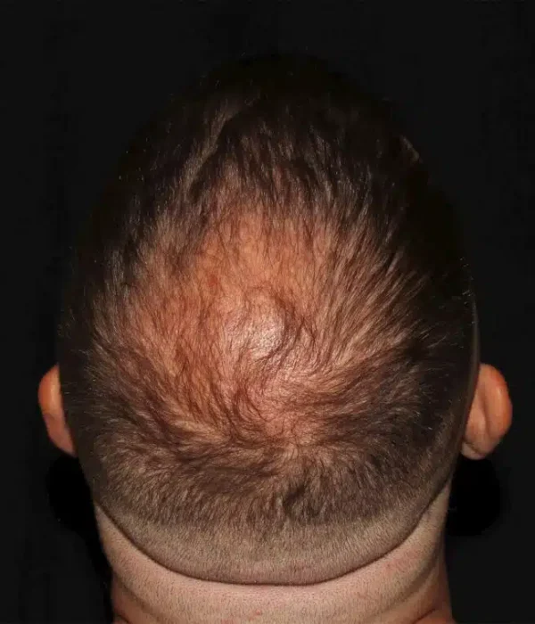 Silk_Touch-mai-neograft-hair-transplant-case-a-before-c-In-Boise-ID