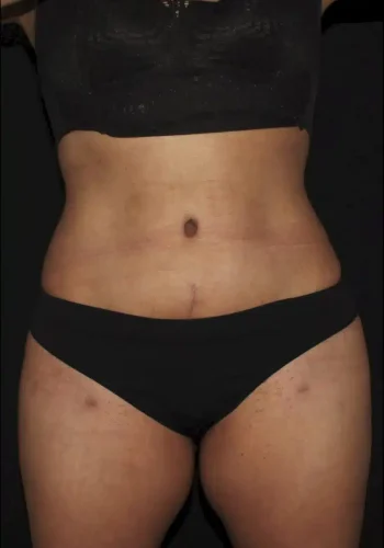 Silk_Touch-mai-tummy-tuck-after-a-In-Boise-ID