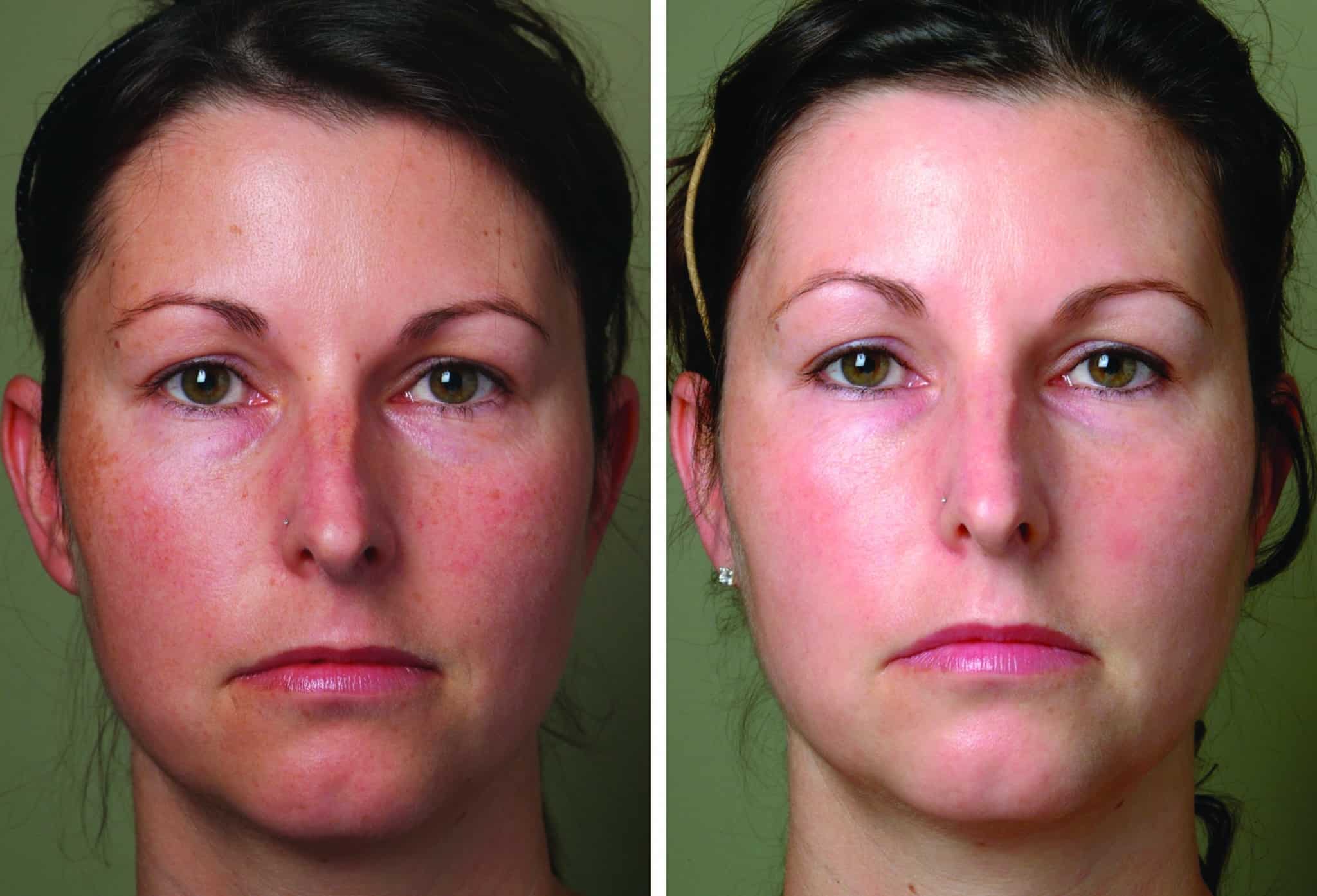 M22 Laser Treatment Boise ID - ResurFX Treatment