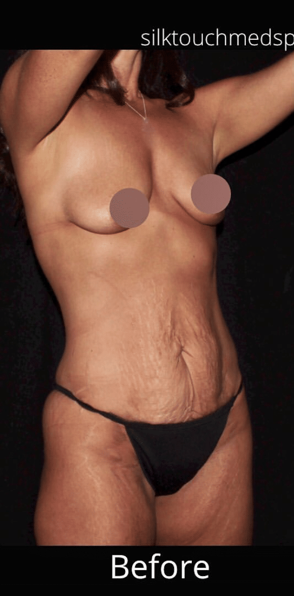 Before Image: Mommy Makeover - right-front-oblique